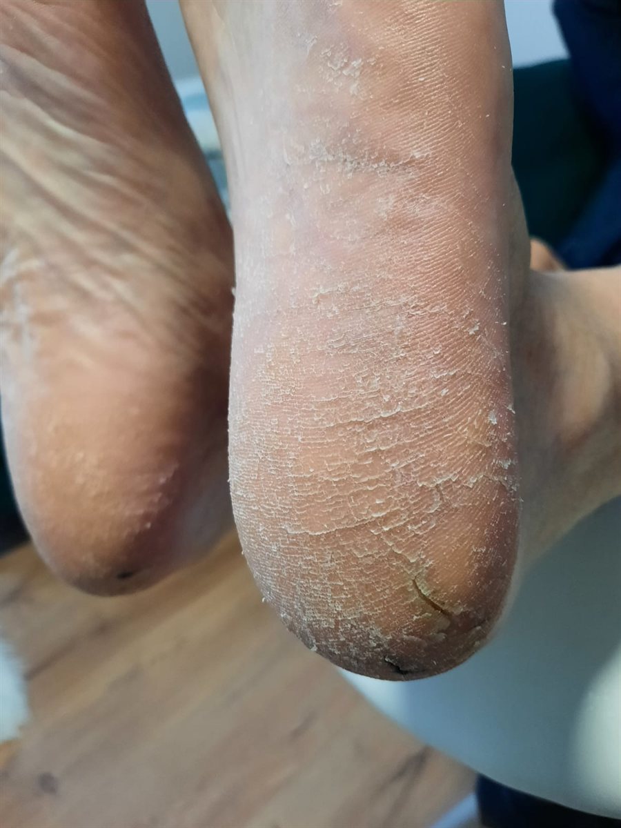 Suha, ispucala peta (ragade) prije obrade